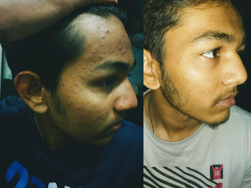 Pimple post image