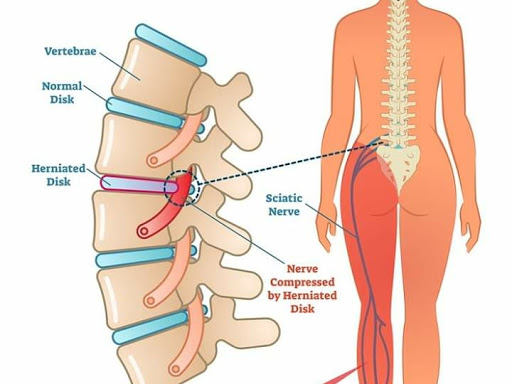 Can be cure Sciatica pain by Physiotherapy& Osteopathy treatment,Call for Best results in S P Phy…
