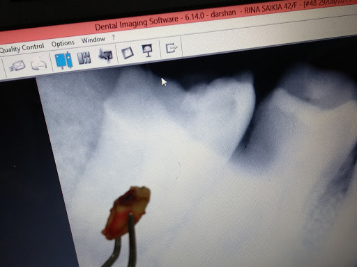 Atraumatic surgical extractions post image