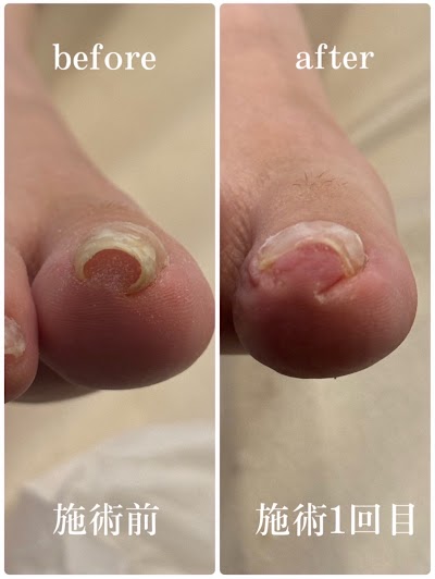 芦屋巻き爪センター