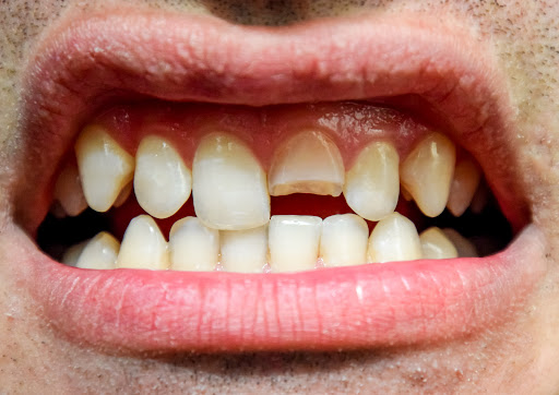 A broken or chipped tooth can occur due to accidents, biting on hard foods, or dental decay. Whil…