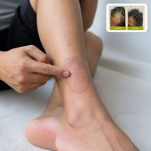 Struggling with itching, rashes or recurring fungal infections on your body? At Dr Akankshas skin… post image