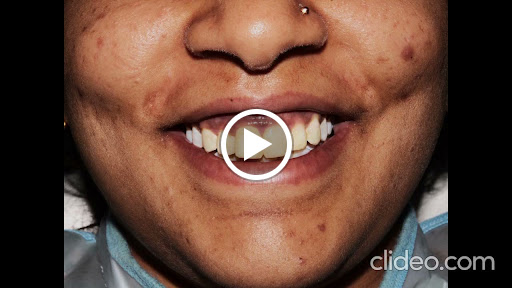 #AuraDentalCare #Veneers #BeautifulSmile #CosmeticDentistry #SmileMakeover post image