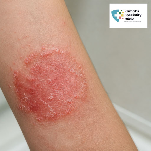 Itchy rashes, redness and boils can spread fast if not treated on time. At Kamat’s Speciality Cli… post image