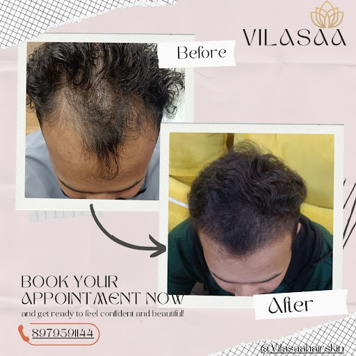 🩸✨ Stronger Hair Starts at the Root with GFC + PRP Treatment ✨🩸