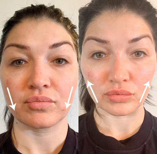 Purely Injectables & Threads