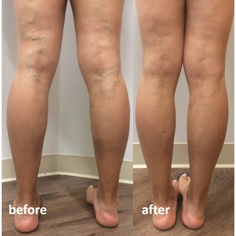 Pleasanton Varicose Vein Treatment // East Bay Vein Specialists