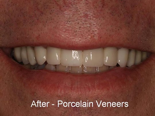 After photo with new Porcelain Dental Veneers