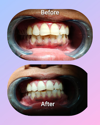 rakshabandhan dental check up post image