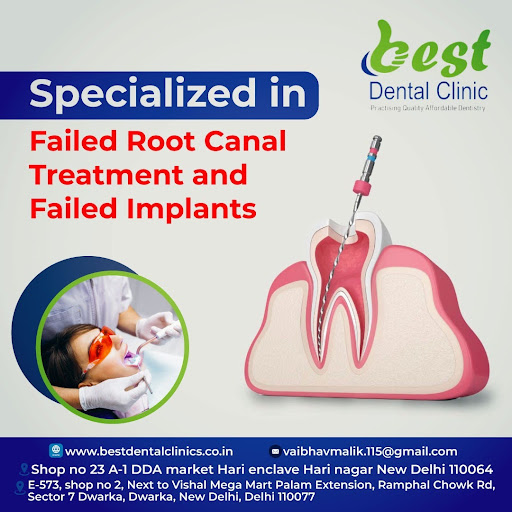 Root canal treatment is a dental procedure that is performed to treat infected or damaged teeth.… post image