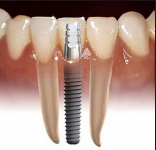 Dental implants & teeth in 3 days. post image