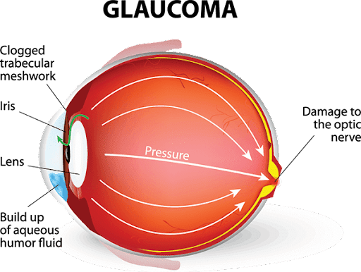 Glaucoma is a group of eye conditions that damage the optic nerve, which is crucial for good visi… post image