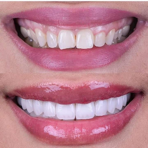 مركز شايني وايت لزراعة وتجميل الأسنان - صورة 4