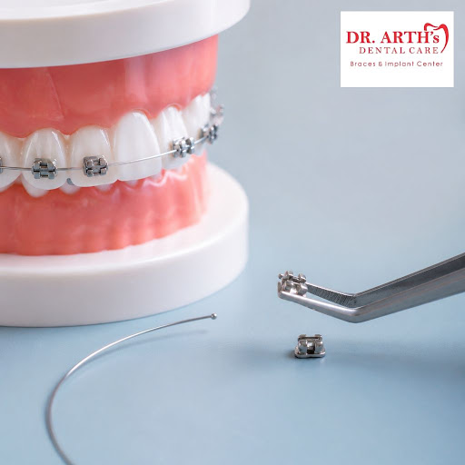 Broken bracket or poking wire bothering you? At Dr Arths Dental Care Braces & Implant Center in J… post image