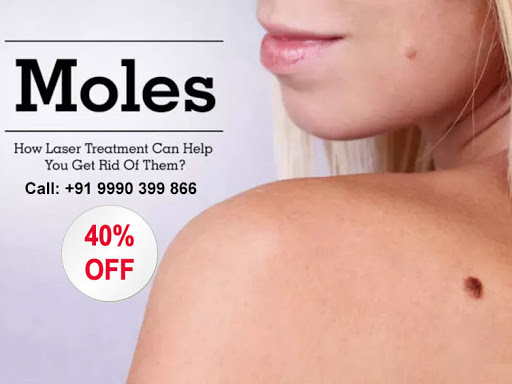 We are known for low cost #moleremovaltreatment in Faridabad, Find ✓Mole Removal Surgery, ✓Laser… post image