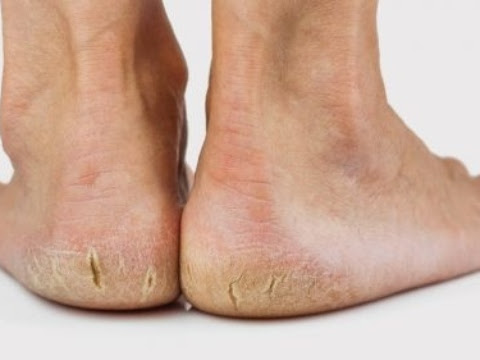 CRACK HEAL AND HOMEOPATHIC  post image