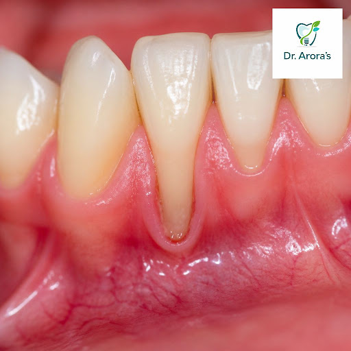 Receding gums making your teeth look longer or feel sensitive? At Dr. Arora's Multispeciality Den… post image