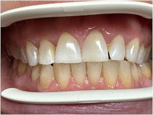 Photo n°19 de Dr Yann Lainé - Chirurgien dentiste Poissy à Poissy (Service de blanchiment des dents)