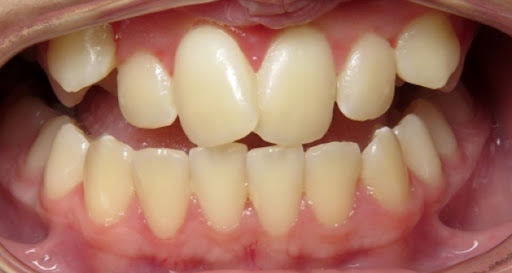 Teeth crowding in kids occurs when there is not enough space in the mouth for teeth to grow and a… post image