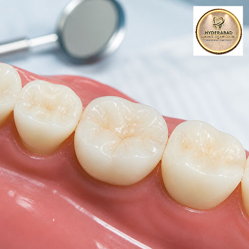 Looking for a long-lasting, natural-looking solution for cavities or chipped teeth? At HYDERABAD… post image