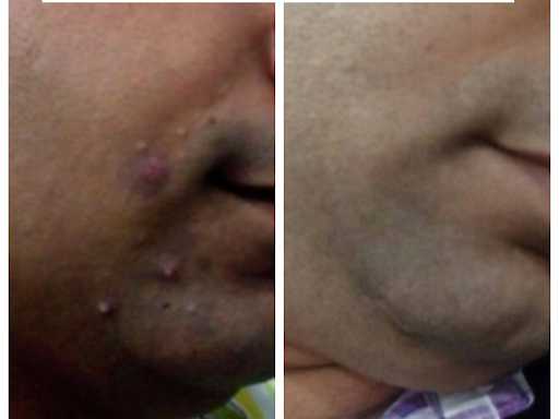 Homoeopathy - always the best pathy for the treatment of warts ! post image