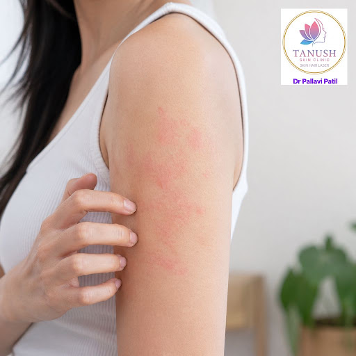 A rash that doesn’t go away can be more than just a skin irritation. At Tanush Skin & Hair Clinic… post image