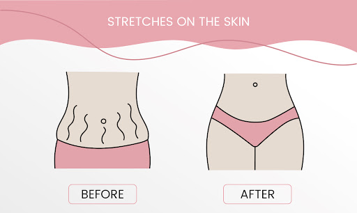 Stretch mark removal does not always mean completely eliminating the marks. Dermatology treatment… post image