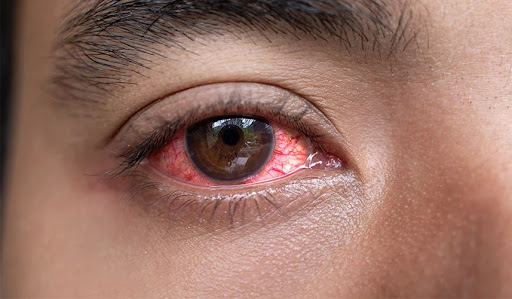 Treatment for Common Eye Problems in Chaksu, Rajasthan post image