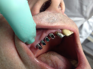 Photo n°14 de implantologie .Dentiste 77.villepinte.Seine et Marne.roissy En France. à Mitry-Mory (Chirurgien)