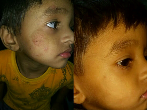 RINGWORM post image
