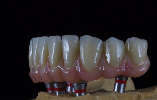 Estética Dental e Implantologia - Thumbnail