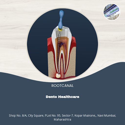 Experience pain-free root canal treatment at Dento Healthcare in Navi Mumbai. Our specialists ens… post image