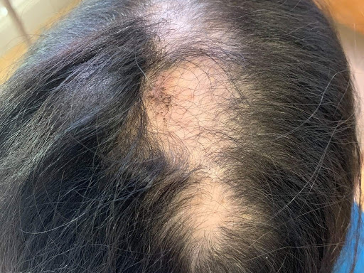 Alopecia treatment