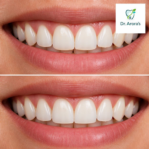 Dreaming of a more even, attractive smile without major dental work? Tooth reshaping at Dr. Arora… post image
