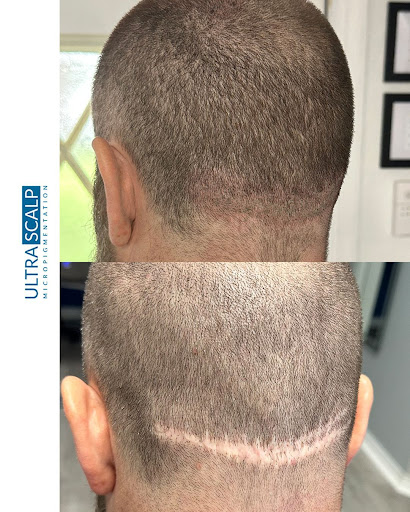 Ultra Scalp Micropigmentation - Thumbnail