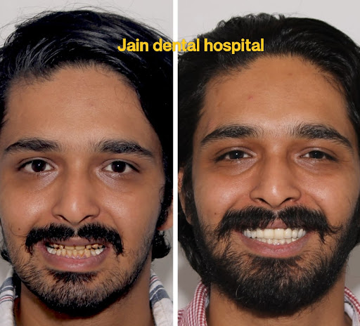 Composite venners post image