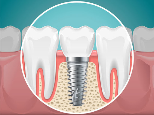 Dental implant cost in Noida