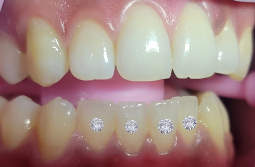 Eclipse Teeth Whitening & Gems Gallery - United States