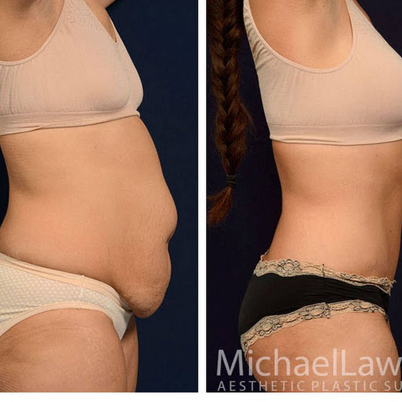 Reverse Upper Modified Lower Abdominoplasty Before & After Photos Raleigh  NC 27614