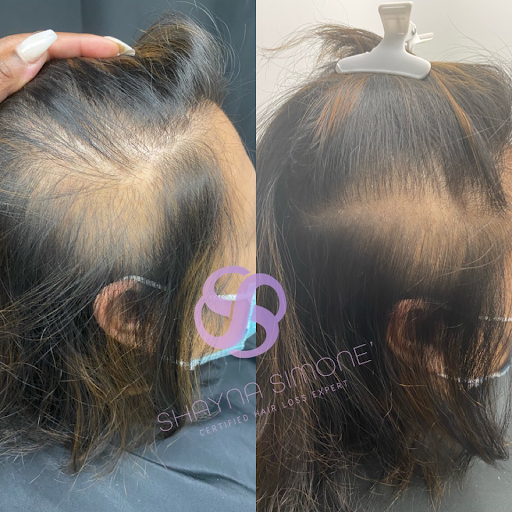 Shayna Simone', Certified Hair Loss Expert - Thumbnail