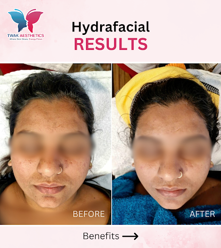 Banish dryness, say goodbye to congestion, hello to a radiant complexion with Hydra-Facial by TWA…