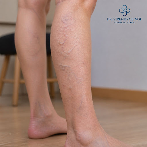 Tired, aching legs and visible veins can affect your confidence as well as your comfort. At the c… post image
