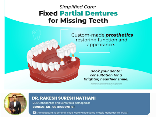 Fixed partial dentures, also known as dental bridges, are prosthetic devices designed to replace… post image