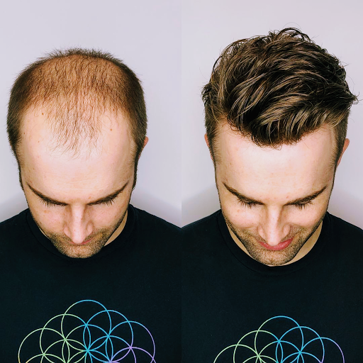 Man Hair - Hair Replacement Solutions Gallery - United States