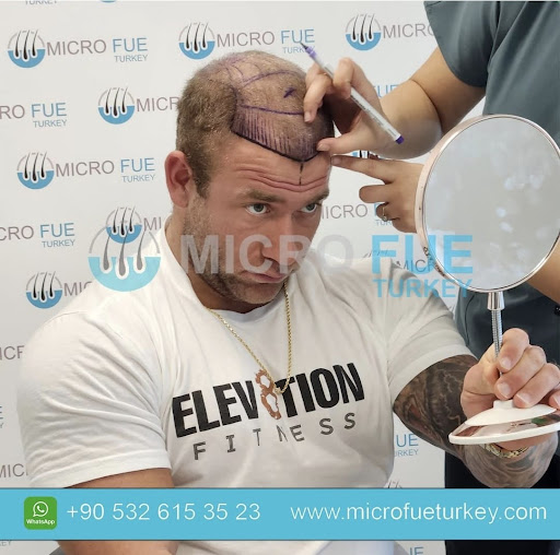 Micro Fue Turkey Marmaris