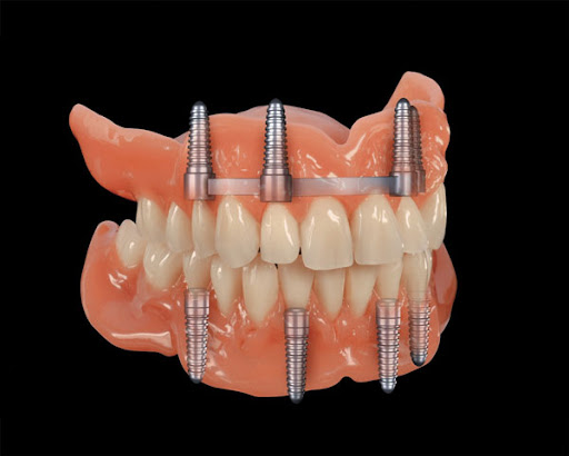 Confidence in your smile can transform not just your appearance, but also your overall well-being… post image