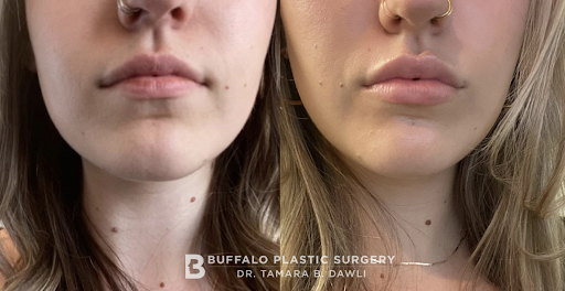 Buffalo Plastic Surgery