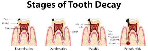 Cavities are one of the most common dental issues among children, but with early intervention and… post image
