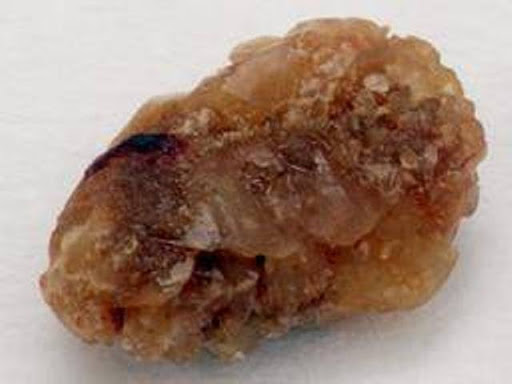 KIDNEY STONE  post image