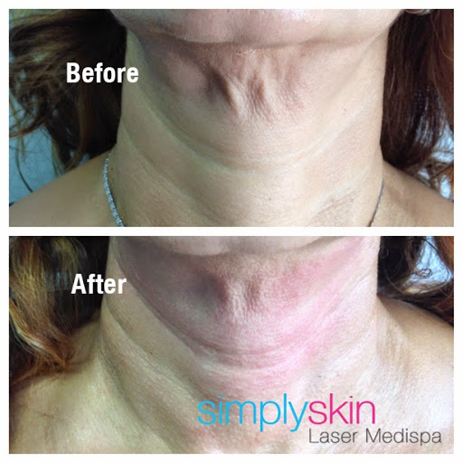 Simply Skin Laser Medispa